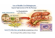 Biliary barrier disruption and phosphatidylcholine deficiency in primary sclerosing cholangitis