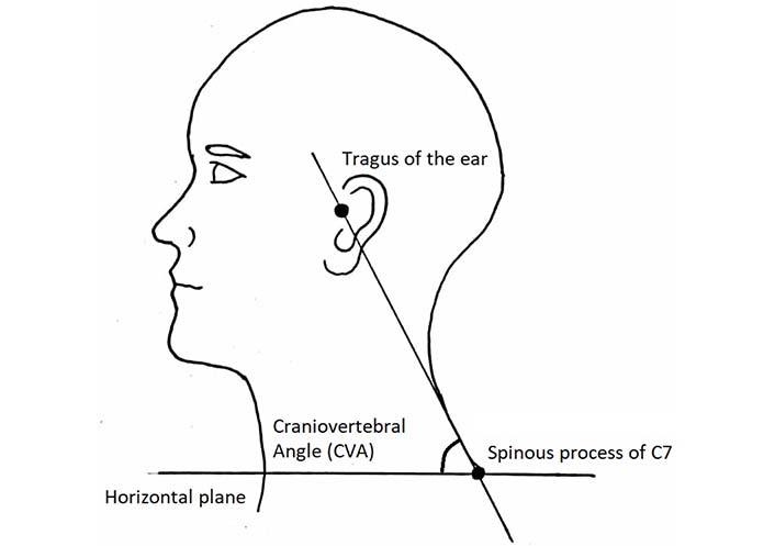 Measurement for upper body posture. A: forward head angle (FHA)