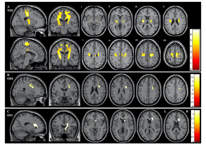 Retracted Diffusion Magnetic Resonance Imaging based Surrogate Marker